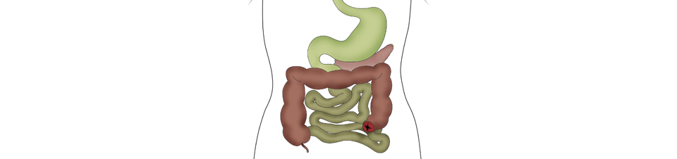 Forstå forskellene på kolostomi, ileostomi og urostomi